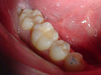 虫歯の処置